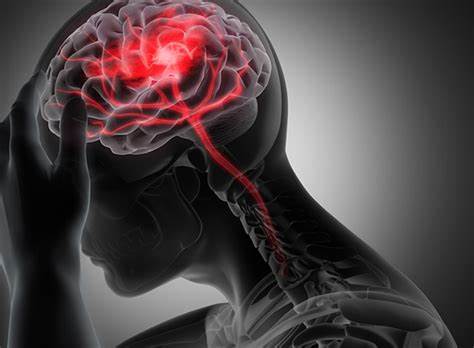 Tắc nghẽn mạch máu não Nguy cơ tiềm ẩn và chìa khóa phòng ngừa hiệu quả